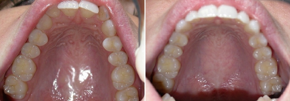 Dr. Avo Fronjian Invisalign Before and After VW5
