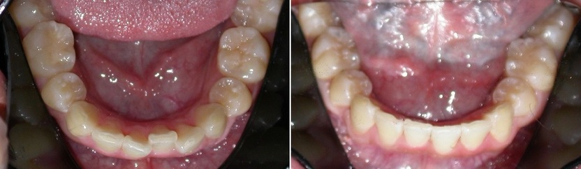 Dr. Avo Fronjian Invisalign Before and After SE3