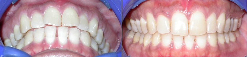 Dr. Avo Fronjian Invisalign Before and After DT3