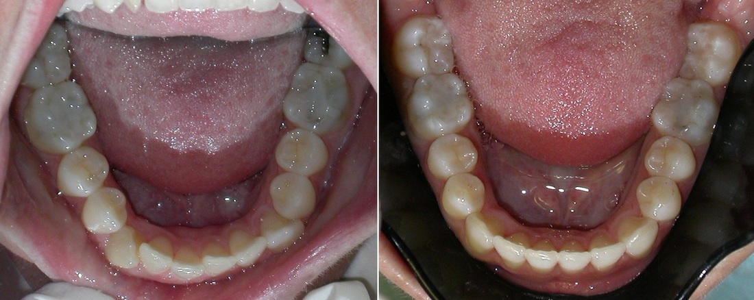 Dr. Avo Fronjian Invisalign Before and After TM8
