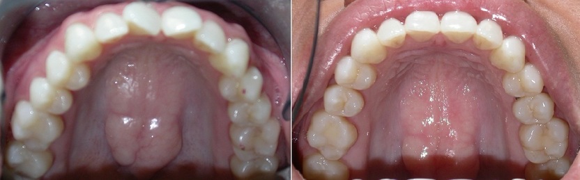Dr. Avo Fronjian Invisalign Before and After SE5