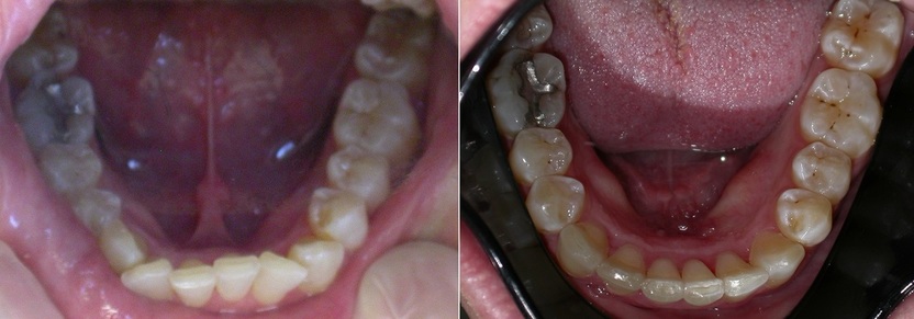 Avo Fronjian Invisalign Before and After KH8