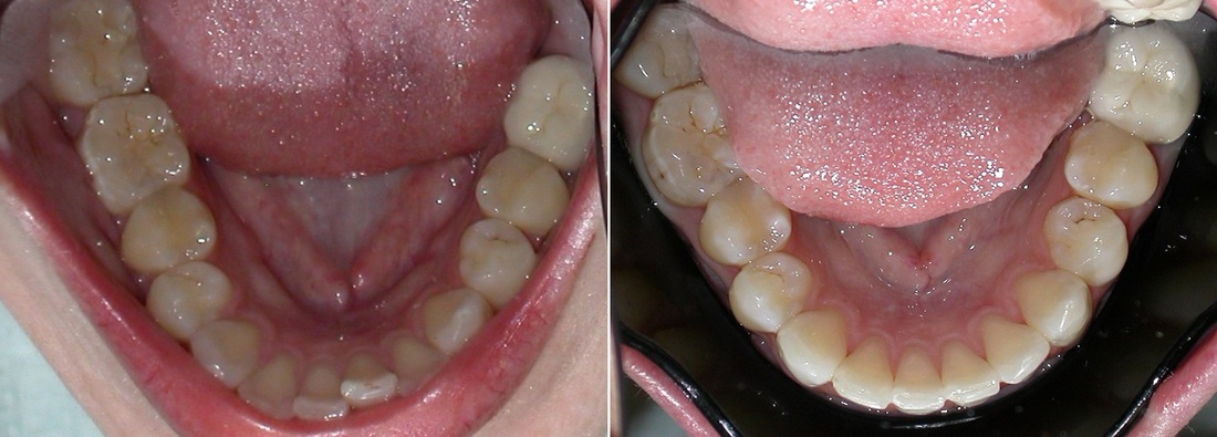 Dr. Avo Fronjian Invisalign Before and After KY7